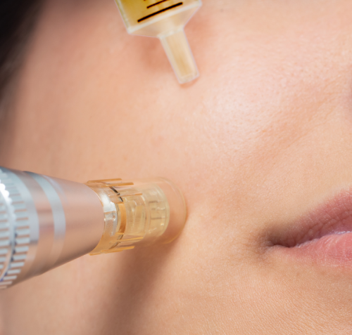 Bare Elegance Rf Micro-Needling