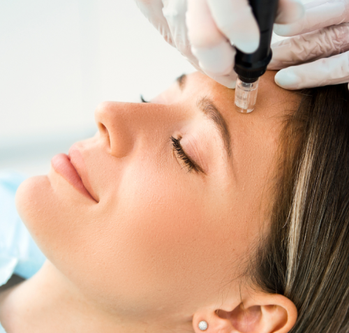 Best Micro-Needling Treatment Near Me
