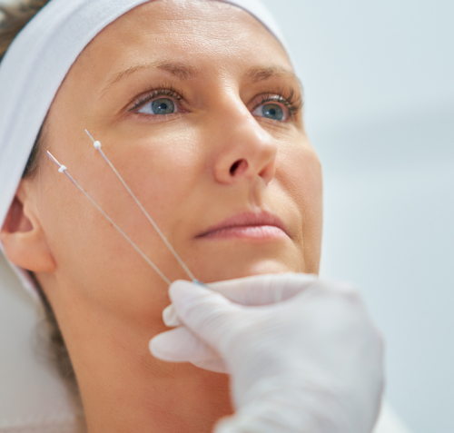 Best Pdo Threads Face Lifting Treatment Near Me
