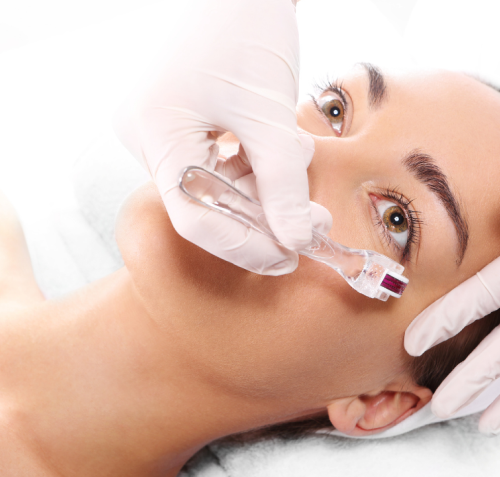 Prp Micro-Needling Treatment For Stretch Marks