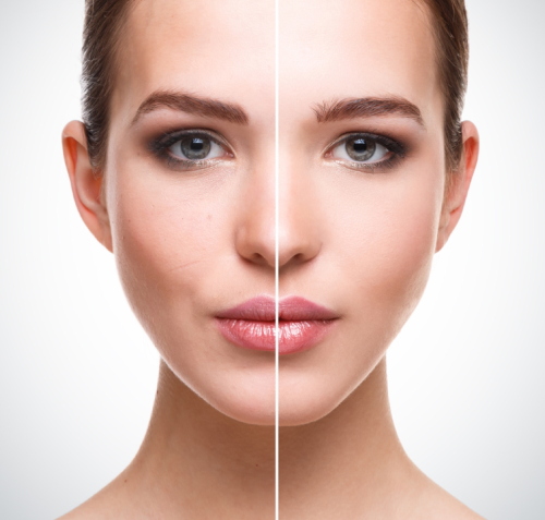 Top Quality Facial Filler For Wrinkles